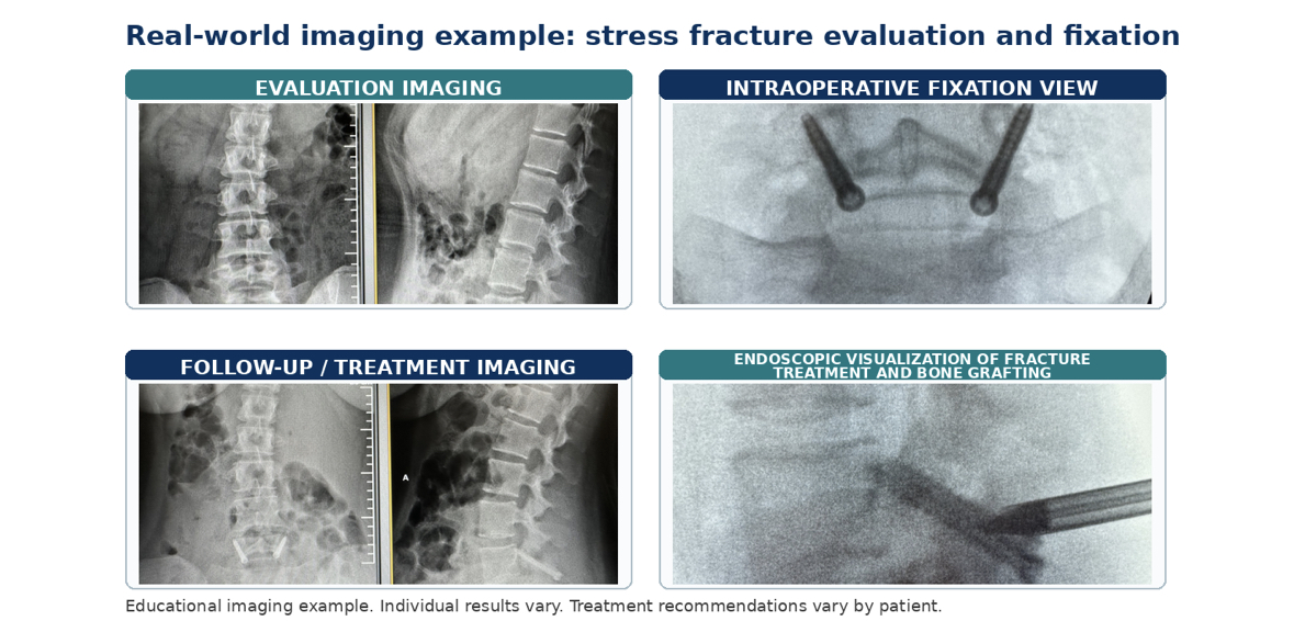 Real-world imaging example of stress fractures of the spine